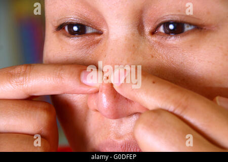 Asian woman squeezing acné sur son nez avec deux doigts Banque D'Images