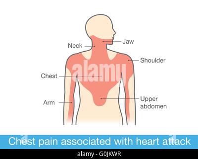 La douleur associée à la crise cardiaque Illustration de Vecteur