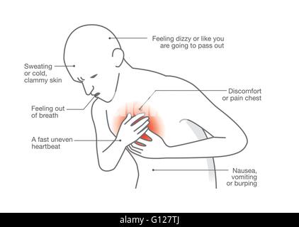 Symptômes de crise cardiaque. Illustration de Vecteur