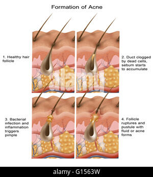 Cross-section illustration de la formation de l'acné en quatre étapes. Du coin supérieur gauche au coin inférieur droit : normal follicule de cheveux, conduit obstrué, une infection bactérienne, et rupture d'un follicule. Banque D'Images