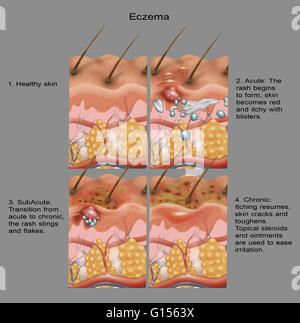 Cross-section illustration de la formation d'eczéma sur la peau en quatre parties. Du coin supérieur gauche au coin inférieur droit : la peau normale, cloques et démangeaisons, la peau devient l'éruption passe de devenir aiguë et chronique, de floconneux et enfin l'éruption devient chronique Banque D'Images