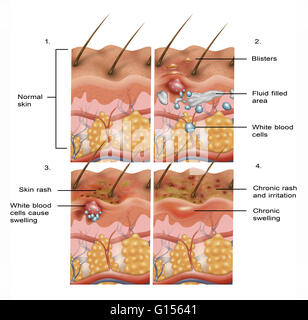 Cross-section illustration de la formation d'eczéma sur la peau en quatre parties. Du coin supérieur gauche au coin inférieur droit : la peau normale, cloques et démangeaisons, la peau devient l'éruption passe de devenir aiguë et chronique, de floconneux et enfin l'éruption devient chronique Banque D'Images