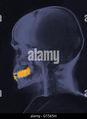 Radiographie d'un crâne d'adulte. Les zones de la bouche d'or indiquent les obturations dentaires. Banque D'Images