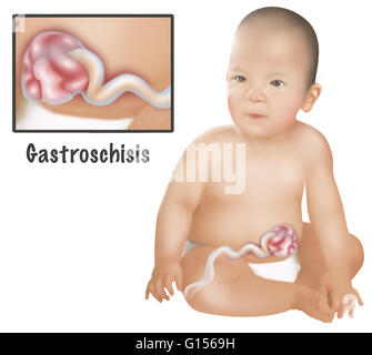 Une illustration d'un bébé avec le gastroschisis. Le gastroschisis est un défaut congénital dans la paroi abdominale antérieure qui permet pour le contenu du système digestif pour dépasser. 1 bébé en 30 est né avec une ou plusieurs anomalies congénitales majeures. La plupart sont correc Banque D'Images