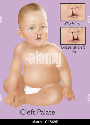 Une Illustration D Un Bebe Avec Une Fente Palatine Une Fente Palatine Est Une Malformation Sympathique