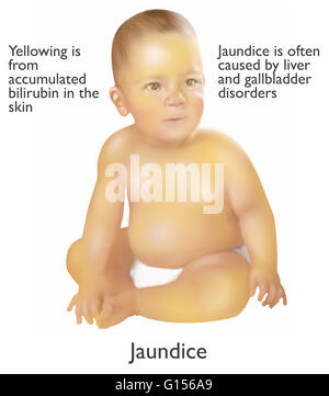 Illustration d'un nourrisson atteint d'ictère. L'ictère est souvent causée par les troubles du foie et de la vésicule biliaire. La couleur jaune vient de bilirubine accumulés dans la peau. Banque D'Images