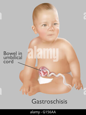 Une illustration d'un bébé avec le gastroschisis. Le gastroschisis est un défaut congénital dans la paroi abdominale antérieure qui permet pour le contenu du système digestif pour dépasser. 1 bébé en 30 est né avec une ou plusieurs anomalies congénitales majeures. La plupart sont correc Banque D'Images