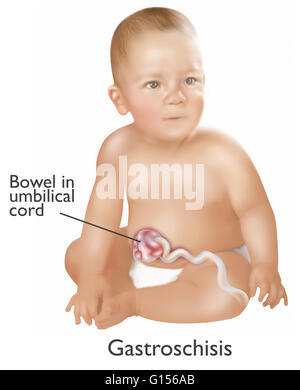 Une illustration d'un bébé avec le gastroschisis. Le gastroschisis est un défaut congénital dans la paroi abdominale antérieure qui permet pour le contenu du système digestif pour dépasser. 1 bébé en 30 est né avec une ou plusieurs anomalies congénitales majeures. La plupart sont correc Banque D'Images