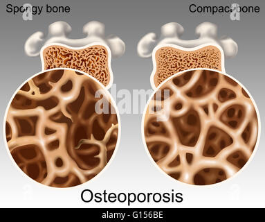 Illustration comparer un os ostéoporotique et normal. L'os ostéoporotique à gauche est un milieu poreux (os spongieux) manque de masse et de la densité. L'os compact à droite montre une masse et de la densité normale. Banque D'Images