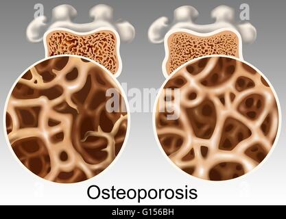 Illustration comparer un os ostéoporotique et normal. L'os ostéoporotique à gauche est un milieu poreux (os spongieux) manque de masse et de la densité. L'os compact à droite montre une masse et de la densité normale. Banque D'Images