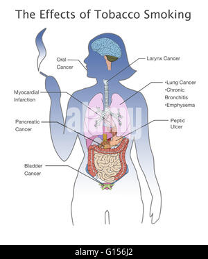 Illustration montrant la grande gamme d'effets nocifs pour la santé que le tabagisme peut causer et leur emplacement dans le corps humain, y compris (dans le sens horaire à partir du haut à gauche) : le cancer de la bouche, cancer du larynx, cancer du poumon, la bronchite chronique, emphysème, ulcère ulce Banque D'Images