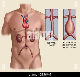 Apparence d'une aorte abdominale normale et une avec l'anévrisme de l'aorte, dans laquelle l'aorte est dilatée. Banque D'Images