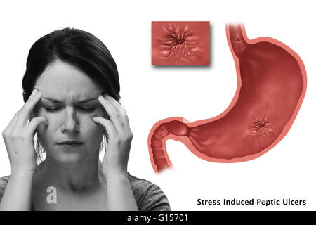 Image conceptuelle d'ulcères causés par le stress. Dans l'estomac illustré il y a un ulcère de l'œsophage, un ulcère gastrique, ulcère duodénal et un présent. Banque D'Images