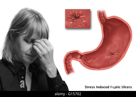 Image conceptuelle d'ulcères causés par le stress. Dans l'estomac illustré il y a un ulcère de l'œsophage, un ulcère gastrique, ulcère duodénal et un présent. Banque D'Images