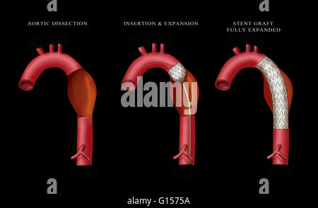 Illustration montrant l'insertion d'une endoprothèse de l'aorte. L'extrême gauche montre la dissection aortique, milieu représente l'insertion et de l'expansion de l'endoprothèse, et d'extrême droite montre le stent graft complètement développé. Banque D'Images