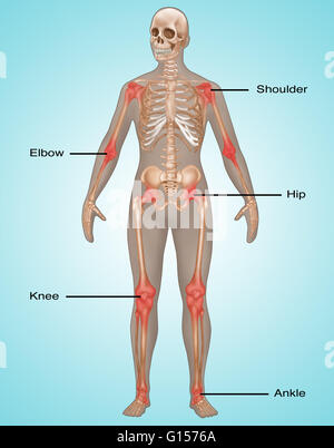 Illustration montrant les lieux communs de la douleur et l'inflammation dans le squelette humain. La douleur commune est représentée en rouge dans l'épaule, coude, hanche, genou, et la cheville. Banque D'Images