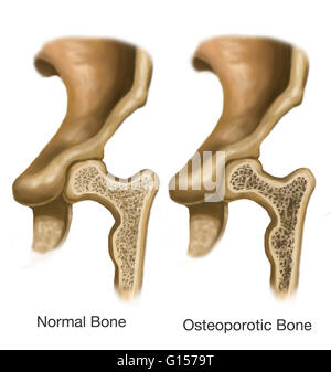 Illustration montrant un os ostéoporotique (à droite) par rapport à un os normal (à gauche). L'os ostéoporotique est un milieu poreux (os spongieux) manque de masse et de la densité. L'os compact affiche une masse et de la densité normale. Banque D'Images