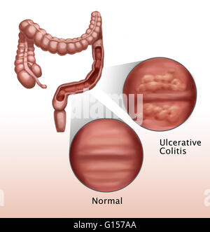 Illustration montrant les effets de la rectocolite hémorragique sur les parois intestinales. La rectocolite hémorragique est une maladie intestinale inflammatoire affectant la paroi interne du gros intestin. La maladie est caractérisée par le développement d'ulcères qui commencer à endommager t Banque D'Images