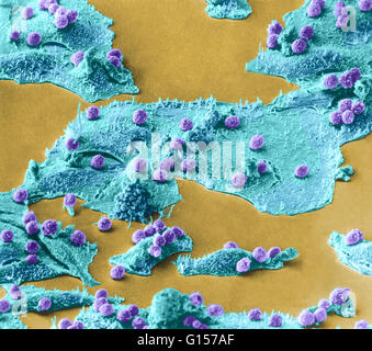 L'analyse des électrons Microphotographie (SEM) montrant les cellules immunitaires (petite sphericals, violet) attaquer des cellules cancéreuses (les grandes étendues, bleu). Inconnu d'agrandissement. Banque D'Images