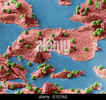 L'analyse des électrons Microphotographie (SEM) montrant les cellules immunitaires (petite sphericals, vert) attaquer des cellules cancéreuses (les grandes étendues, rose). Inconnu d'agrandissement. Banque D'Images