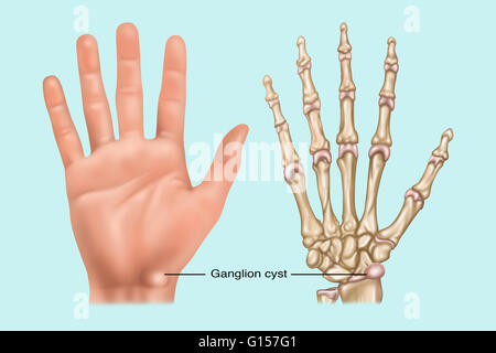 Illustration montrant un kyste ganglionnaire (sac rempli de fluide) dans le poignet. Illustré à la fois sur la surface de la peau et sur l'os. Banque D'Images