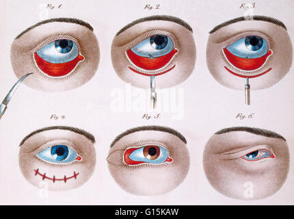 Illustration montrant l'intervention chirurgicale pour corriger une paupière inférieure (ptose), ch. 1830. Le Ptosis est un trille ou la chute de la paupière supérieure ou inférieure. La chute risque d'être pire après avoir été éveillé plus longtemps, lorsque l'individu ses muscles sont fatigués. Cette c Banque D'Images