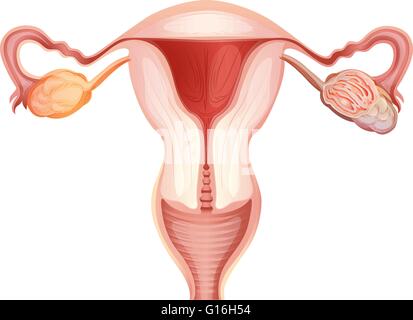 Le cancer de l'ovaire chez la femme illustration Illustration de Vecteur