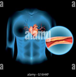 La maladie cardiaque causée par cholesteral illustration Illustration de Vecteur