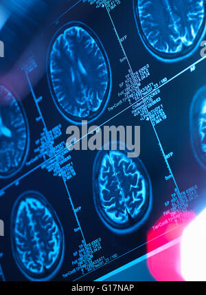 Scan du cerveau humain dans une clinique de neurologie Banque D'Images
