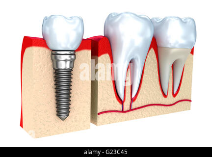 Couronne dentaire implant , et les dents , image 3D . Banque D'Images