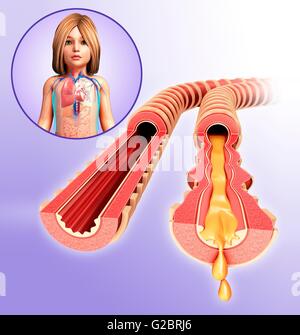 Bronches infectées d'un enfant, de l'illustration. Banque D'Images