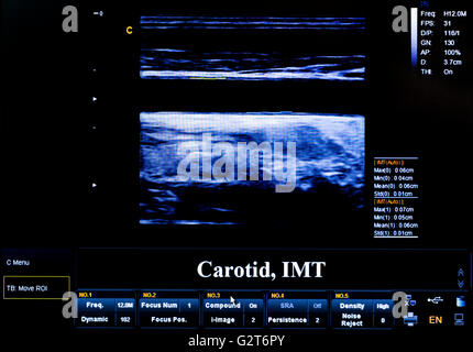 Échocardiographie moderne (échographie) ce moniteur. Image couleur. Nouveau hospitl équipement. L'artère carotide. Banque D'Images