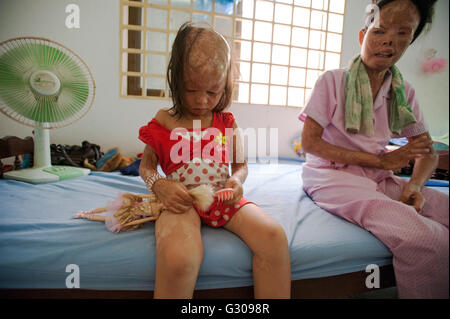 La violence à l'acide cambodgiens survivants Chheav Chenda et sa fille Bun Cheata Acid Survivors cambodgien à la charité (ACCS). Banque D'Images