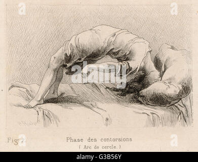 Malade mentale à la Salpetriere, en passant par la phase de contorsions Date : 1881 Banque D'Images