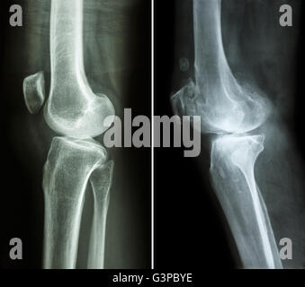 Genou normal ( image de gauche ) et de l'arthrose du genou ( image de droite ) ( vue latérale ) Banque D'Images