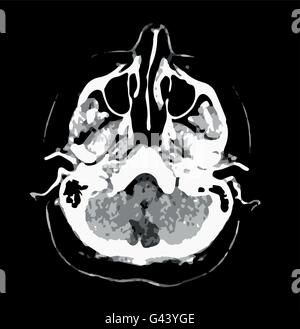 CT scan de cerveau. Le noir et blanc graphique de scénario. Les soins de santé. Diagnostic de problèmes de santé. Tête humaine. Illustration de Vecteur