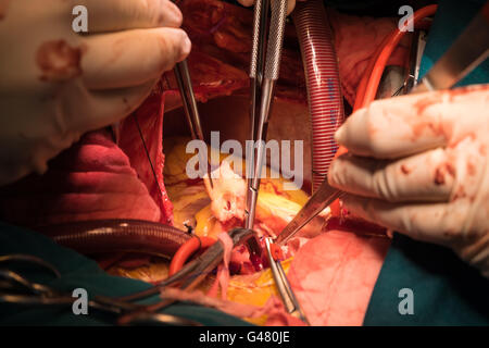 L'opération de bentall par ordre croissant d'anévrisme aortique Banque D'Images