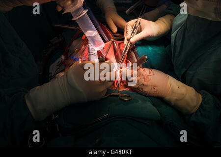 L'opération de bentall par ordre croissant d'anévrisme aortique Banque D'Images