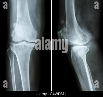 L'arthrose du genou . film x-ray ( genou - antérieure et postérieure vue latérale ) montre l'espace mixte étroit éperon ) , ('ostéophyte Banque D'Images