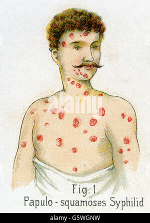 Médecine, maladies sexuellement transmissibles, syphilis, syphilis papulosquamous, de: Friedrich Eduard Bilz, Nouveau traitement naturopathique, Leipzig, Allemagne, 1902, droits additionnels-Clearences-non disponible Banque D'Images