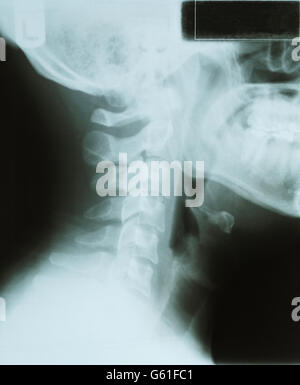 Vue de côté X Ray de la nuque et de la tête. Banque D'Images
