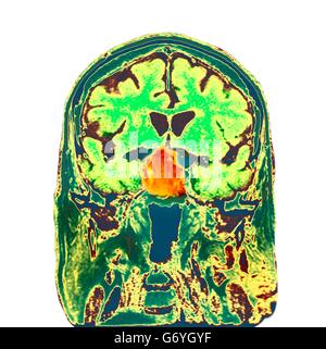 Tumeur de l'hypophyse. La tomographie de couleur (CT) d'une section à travers le cerveau d'un 84-year-old male patient avec une tumeur (ronde, centre) qui ont une incidence sur l'hypophyse. Les tumeurs hypophysaires sont habituellement bénignes adénomes - (non-cancéreuse) Ari Banque D'Images