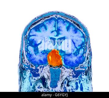 Tumeur de l'hypophyse. La tomographie de couleur (CT) d'une section à travers le cerveau d'un 84-year-old male patient avec une tumeur (ronde, centre) qui ont une incidence sur l'hypophyse. Les tumeurs hypophysaires sont habituellement bénignes adénomes - (non-cancéreuse) Ari Banque D'Images