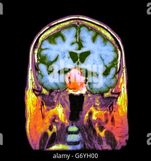 Tumeur de l'hypophyse. La tomographie de couleur (CT) d'une section à travers le cerveau d'un 84-year-old male patient avec une tumeur (ronde, centre) qui ont une incidence sur l'hypophyse. Les tumeurs hypophysaires sont habituellement bénignes adénomes - (non-cancéreuse) Ari Banque D'Images