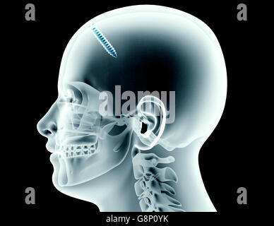 X-ray image d'un crâne avec une vis, 3d illustration Banque D'Images