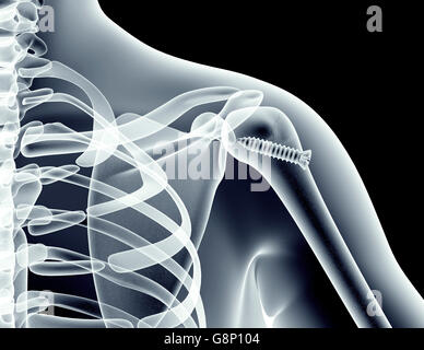 X-ray image d'un os à l'aide d'une vis, 3d illustration Banque D'Images