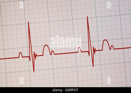 Flatline écho sur un moniteur cardiaque médical / ECG ECG (électrocardiogramme) avec fond blanc Banque D'Images