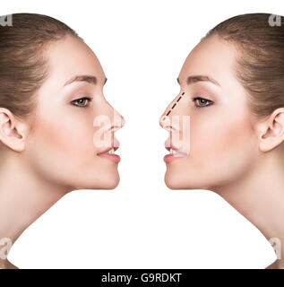 Femme avant et après chirurgie du nez cosmétiques Banque D'Images