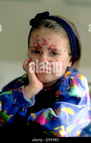 Petite fille avec la varicelle Banque D'Images