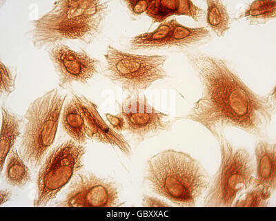 Photomicrographie de cellules stromales de l'endomètre humain tachées par immunocytochimie de protéine de la vimentine (marron), 40x. Banque D'Images